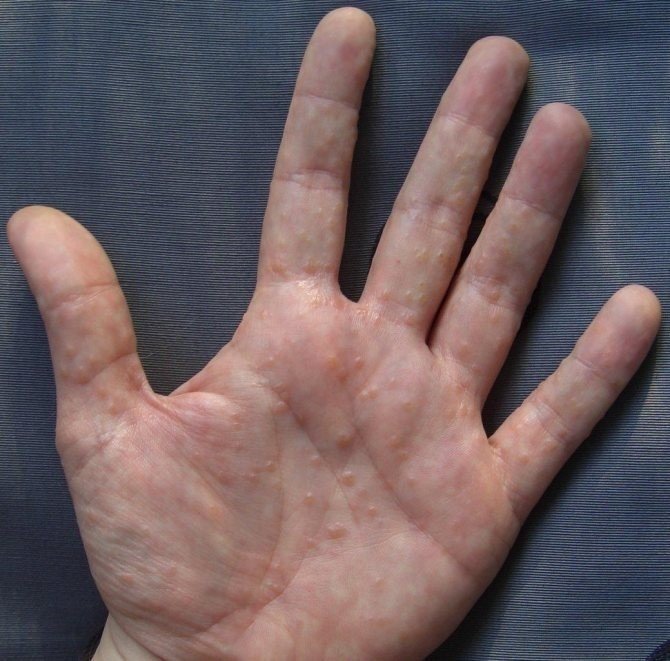 Дисгидроз кистей рук